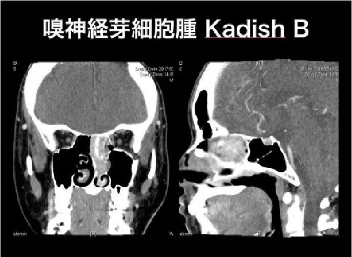 嗅神経芽細胞腫 Kadish B